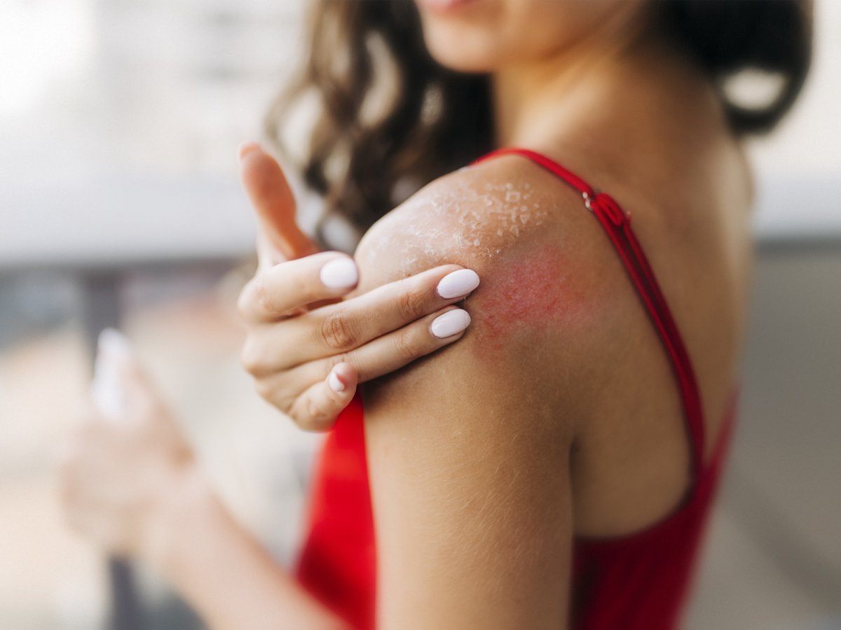 Алергія на сонце: симптоми, причини, лікування
