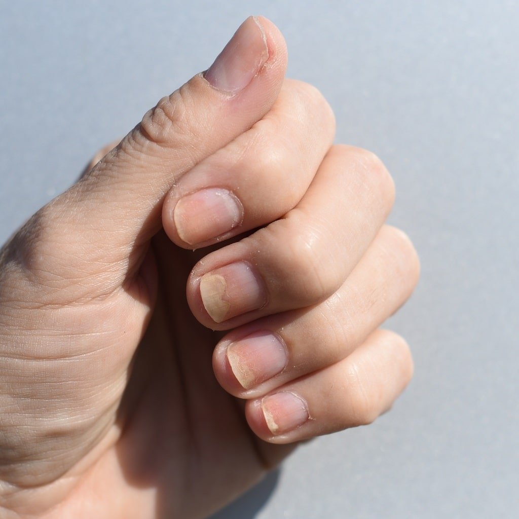 Онихолизис - отслоение ногтей