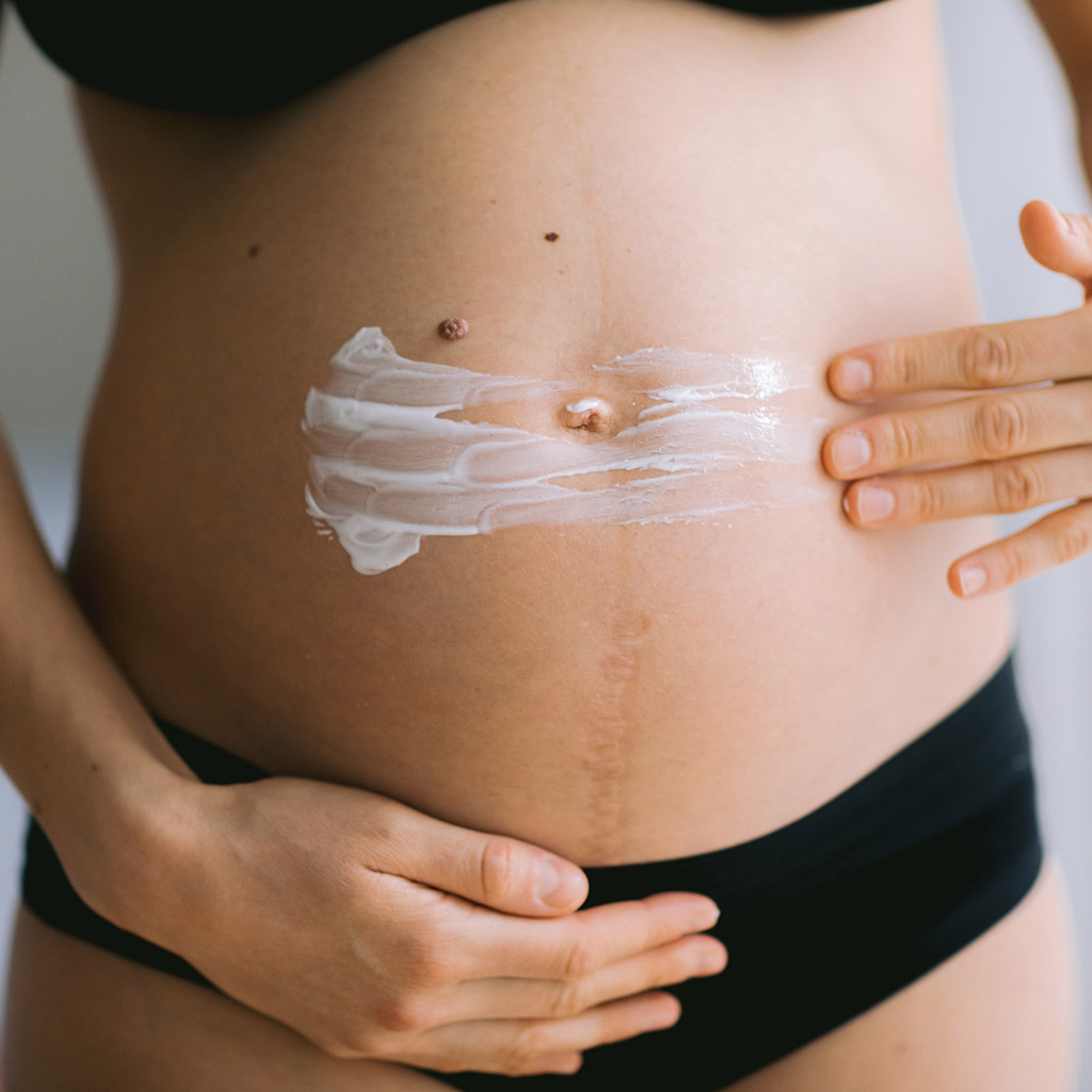 Як попередити появу пігментації під час вагітності