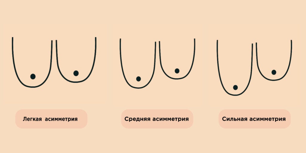 Виды асимметрии груди