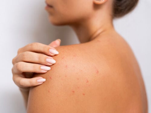 0-Акне-на-тілі