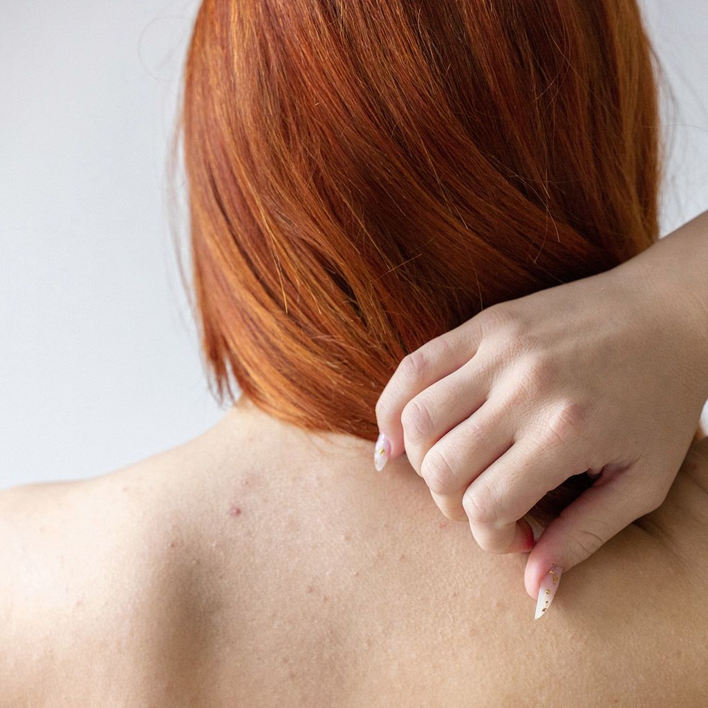 1-Акне-на-тілі