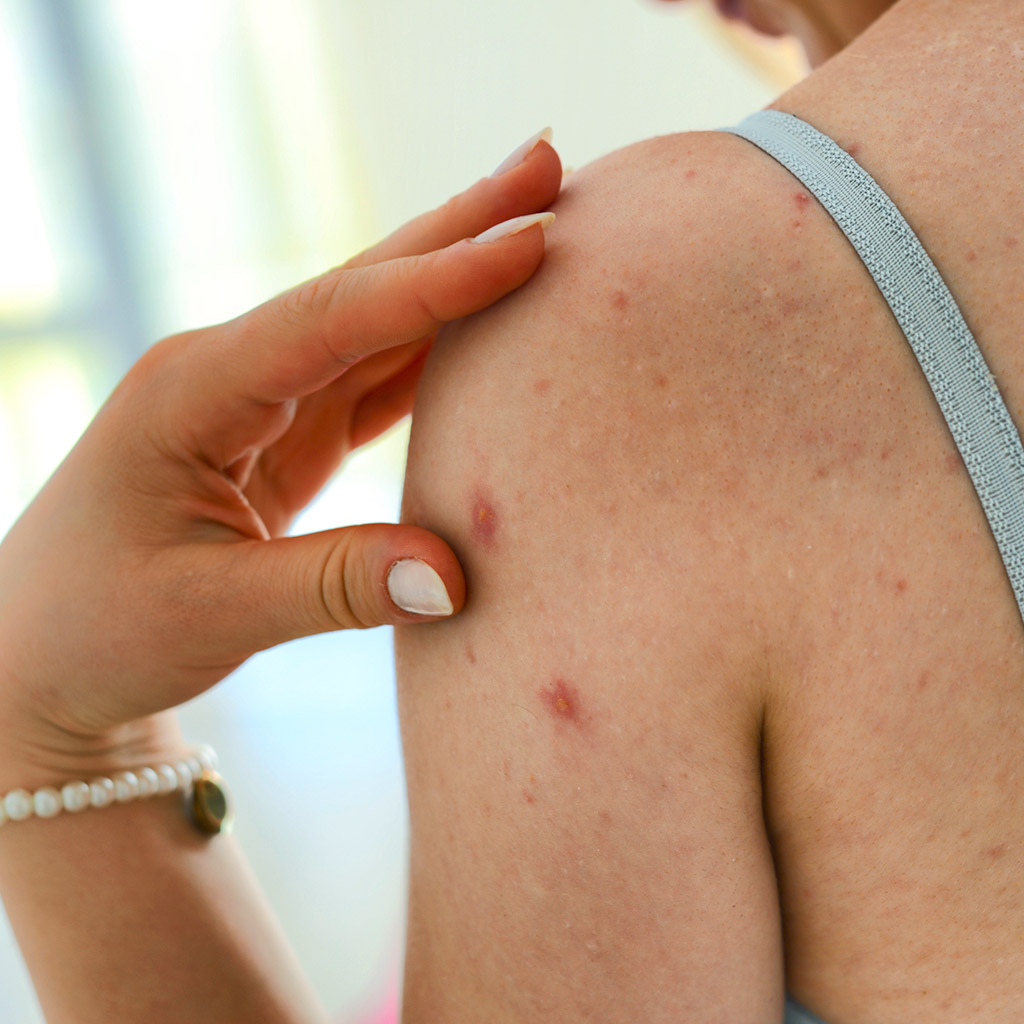 2-Акне-на-тілі