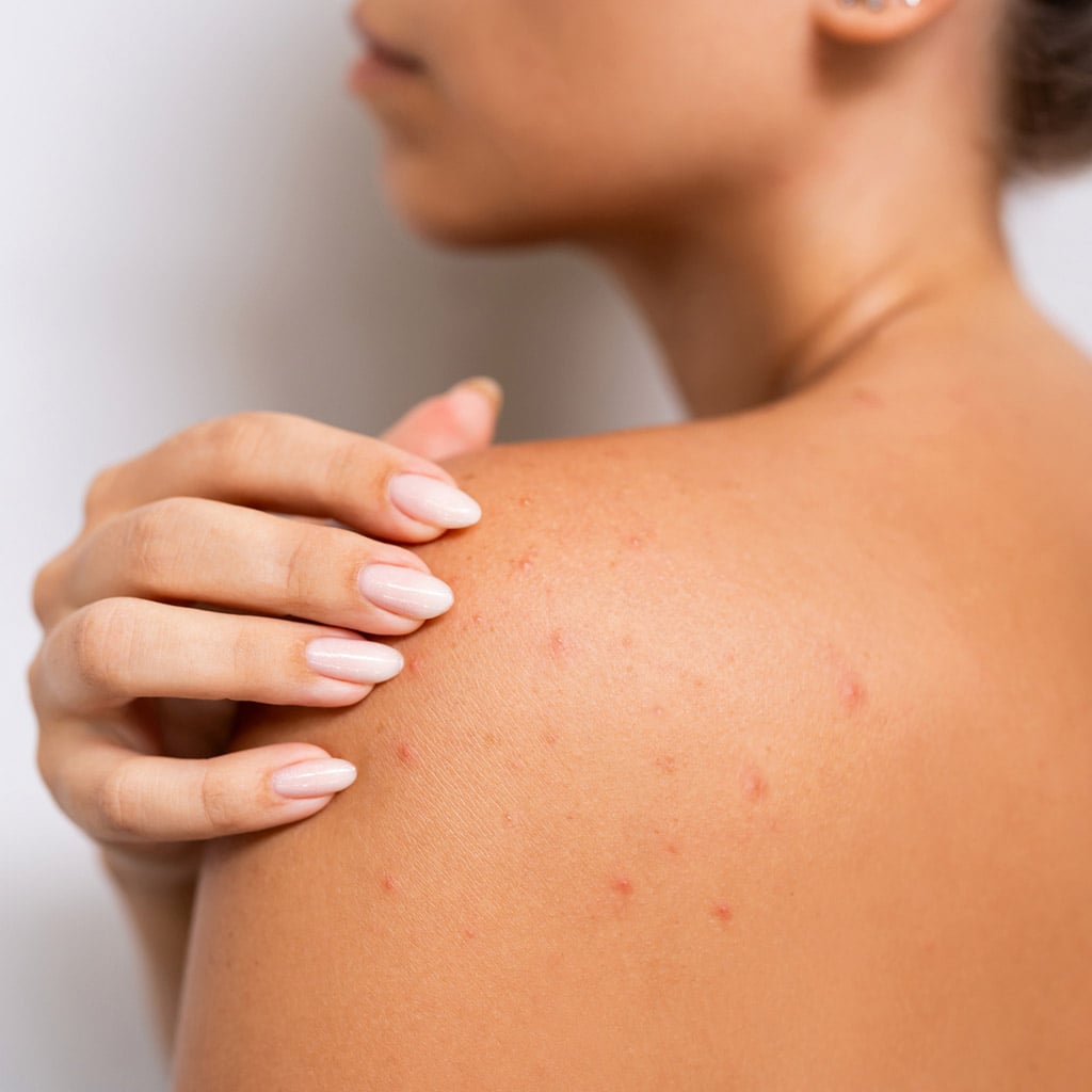 4-Акне-на-тілі