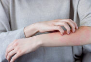 0-Все,-що-тобі-потрібно-знати-про-холодову-алергію