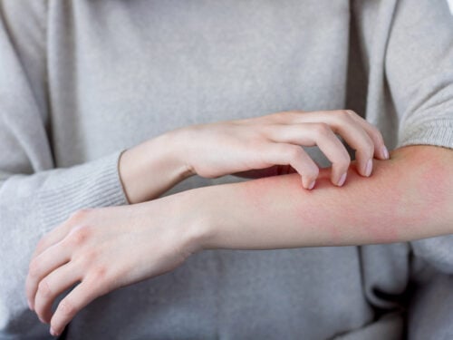 0-Все,-що-тобі-потрібно-знати-про-холодову-алергію