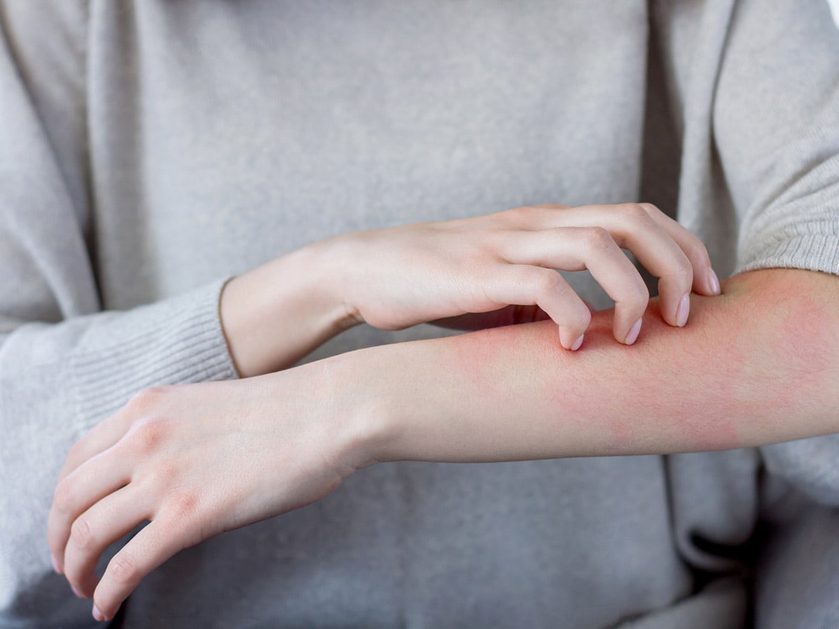 0-Все,-що-тобі-потрібно-знати-про-холодову-алергію