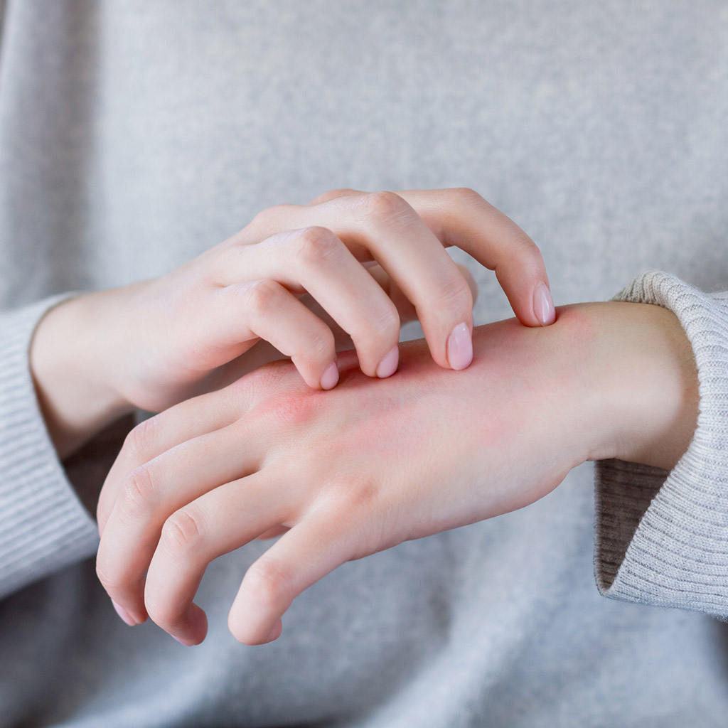 2-Все,-що-тобі-потрібно-знати-про-холодову-алергію