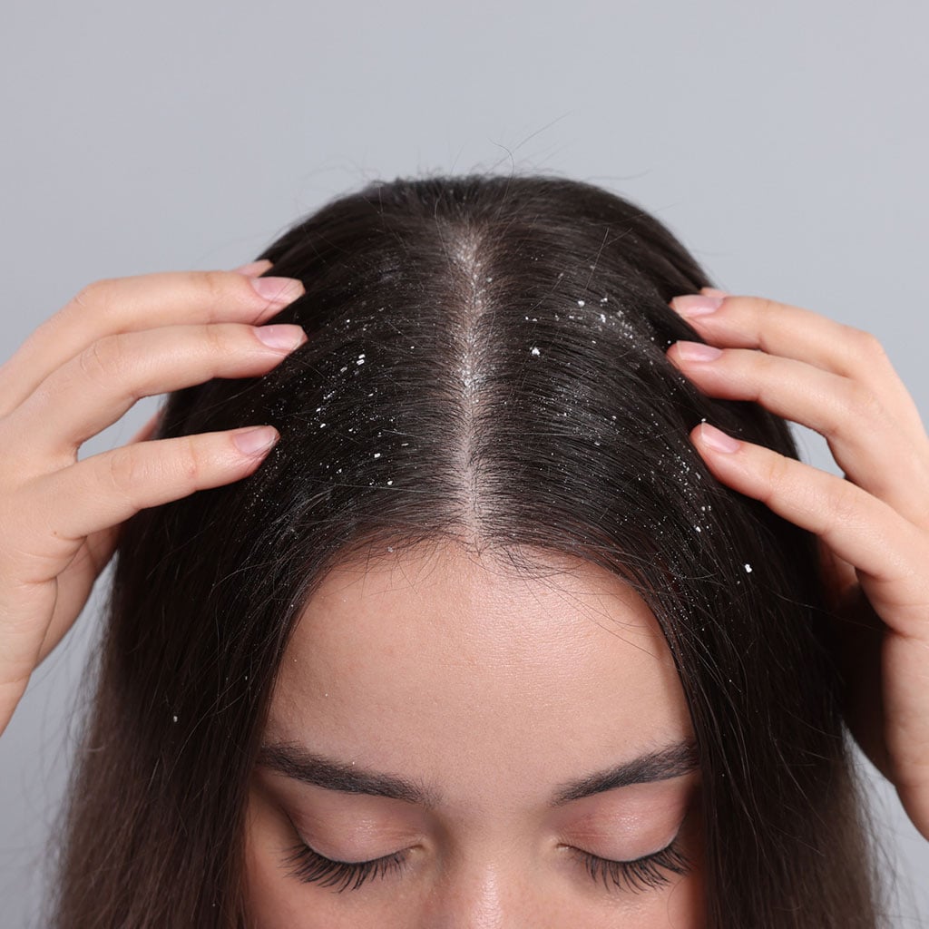 1-Поширені-помилки-в-догляді-за-шкірою-голови,-які-сприяють-появі-лупи