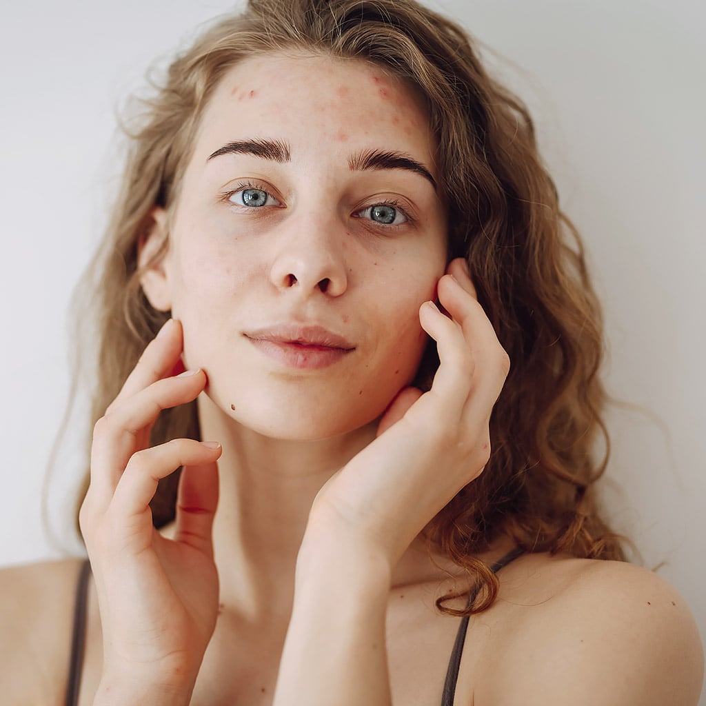 16-Жирна-шкіра