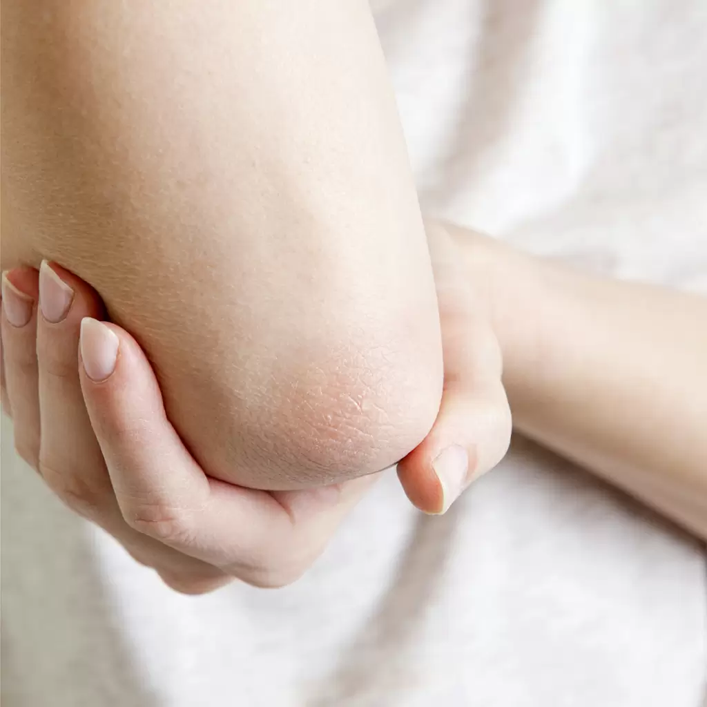 Ксероз - причины появления и лечение чрезмерной сухости кожи